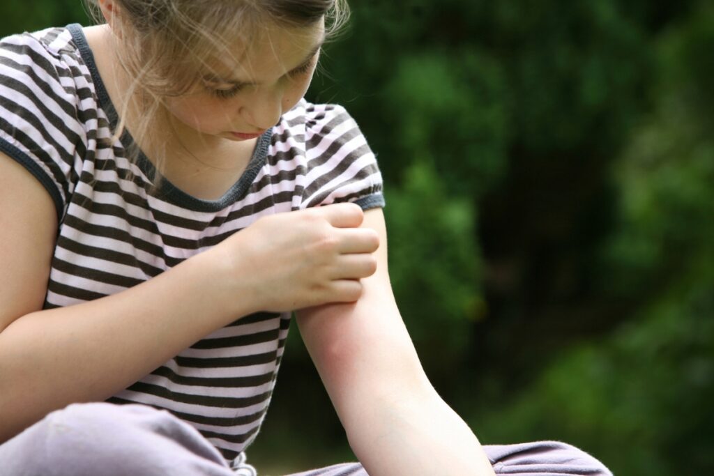 Girl looking at mosquito bit on her arm